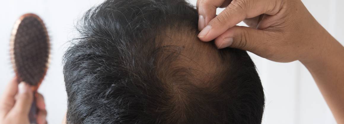 Mikä aiheuttaa hiusten ohenemista ja hiustenlähtöä?