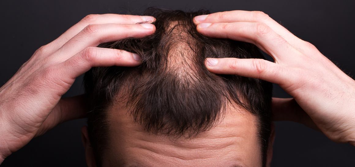 Voiko CBD-öljy auttaa hiuksiasi kasvamaan?