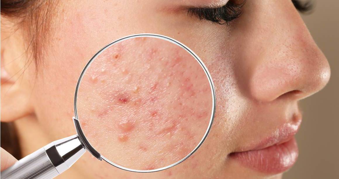 Kuinka kauan kestää täysin Clear Acne