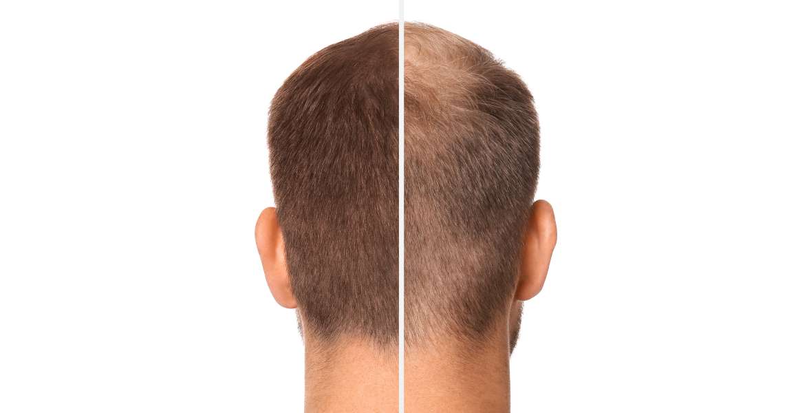 Auttaako Omega-3 hiusten kasvua?